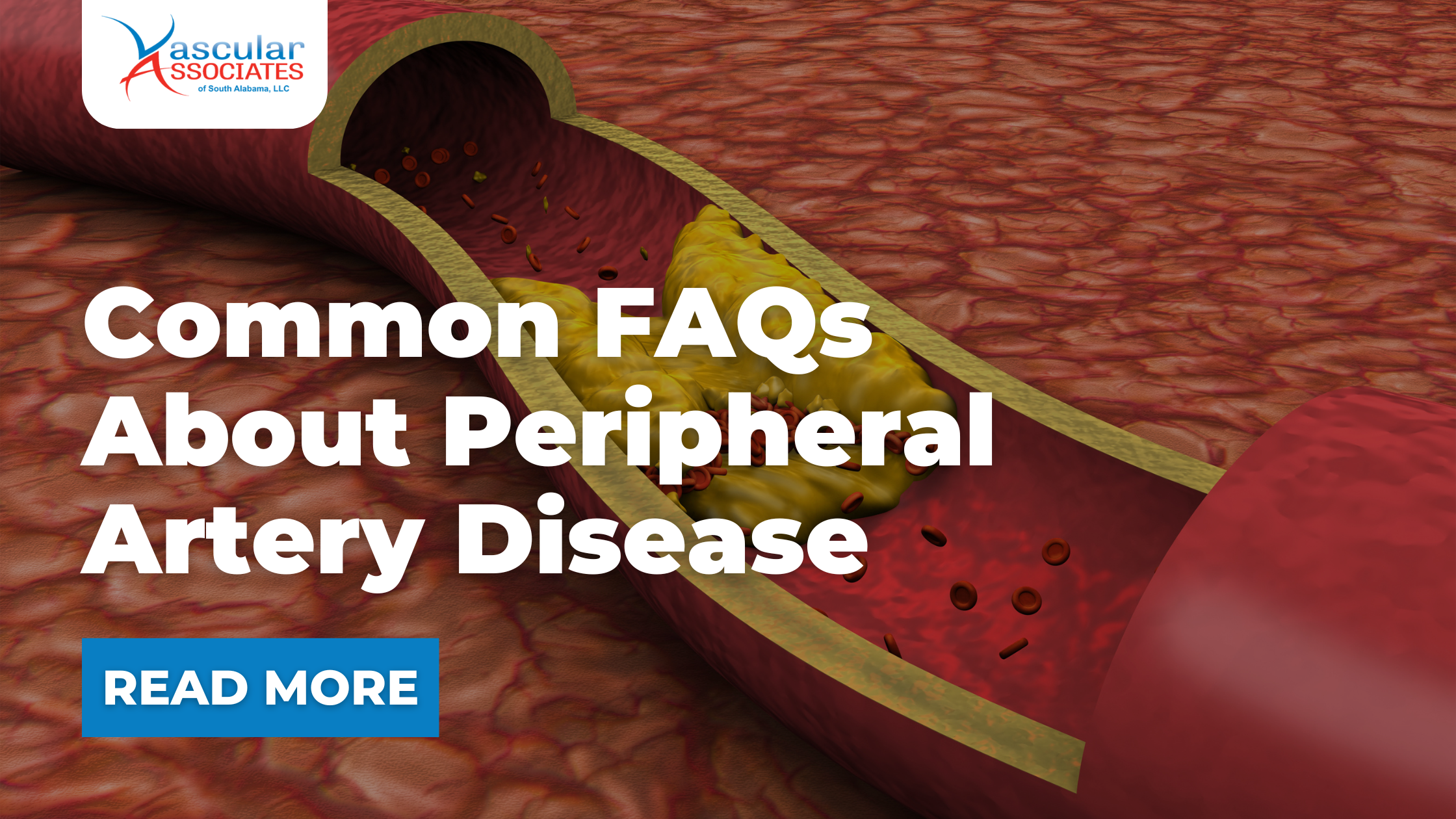 Common FAQs About Peripheral Artery Disease .png